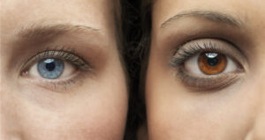 can-eyes-change-color-keratopigmentation-laser