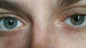 눈 색깔 변화 수술