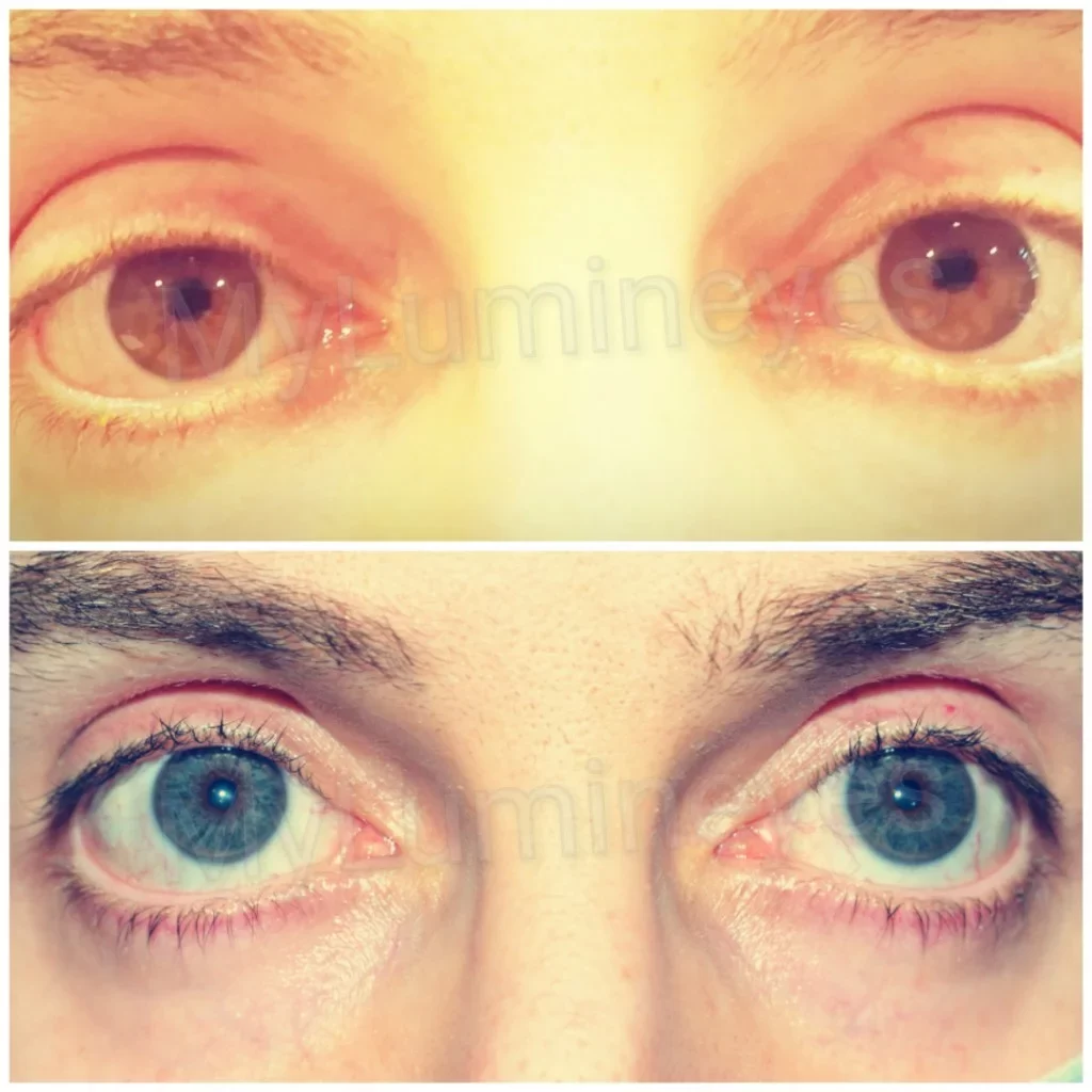 Вашето тяло здраве лазерна операция за промяна на цвета на очите чрез