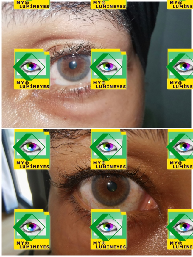 промяна на здравето на цвета на очите