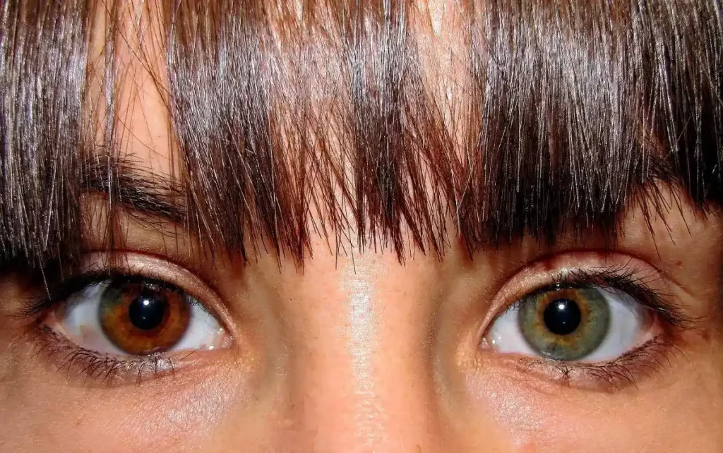 what is heterochromia and treatments