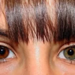 what is heterochromia and treatments